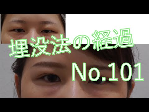 埋没法110　重ための一重まぶたから埋没法で二重へ