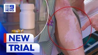 New trials for pill to treat skin pigment condition Vitiligo | 9 News Australia