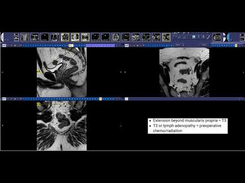 How to read  Rectal Cancer MRI