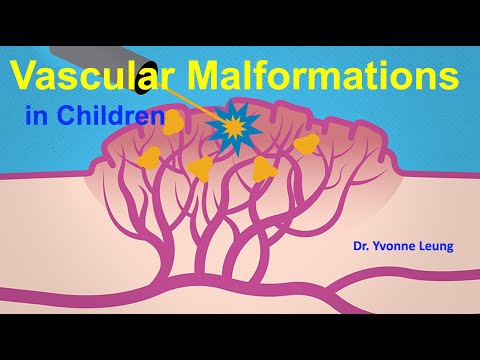 Vascular Malformations by Dr. Yvonne Leung