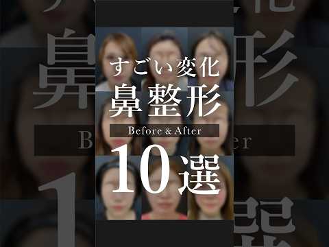 鼻整形人気症例10選💐形成外科専門医が担当する、自然かつしっかり変化する鼻整形がこちらです💪