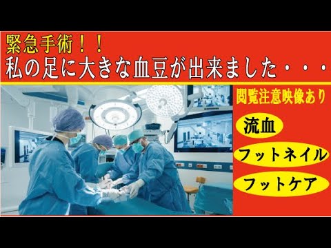 【緊急手術セルフネイル】フットケア感覚で血豆除去？自宅で血豆を応急処置する方法！