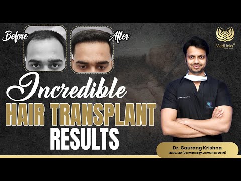 Incredible Hair Transplant Results | Medlinks