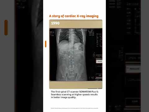 Imaging the human heart: from 1896 to today | #radiology #xrays #computedtomography