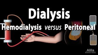 Renal Replacement Therapy: Hemodialysis vs Peritoneal Dialysis, Animation