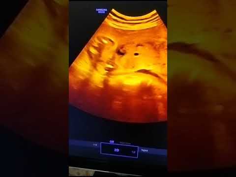 26 week pregnancy #pregnancy #pregnant  #ultrasound #sonographer #health #ultrasoundtech #science