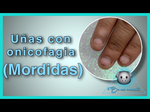 Atendiendo uñas con onicofagia, uñas mordidas.