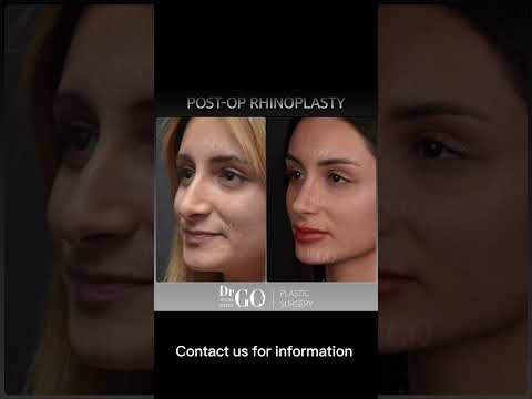 Before and after rhinoplasty - Dr Guncel Ozturk #beforeandafter #rhinoplastyturkey #drgo