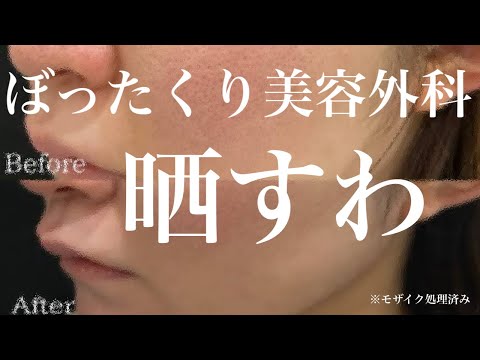 【潜入捜査】ポテンツァぼったくってきた美容外科晒すわ〜ニキビ跡、傷跡修正