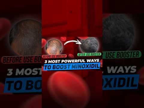 3 Best Minoxidil Boosters