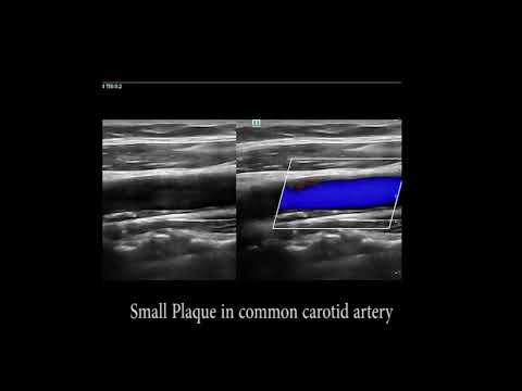 Carotid artery and carotid plaque