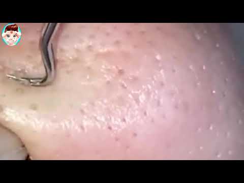 How To Remove A Blackhead