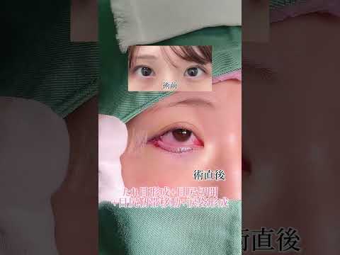 【たれ目形成の術直後】の様子☺︎