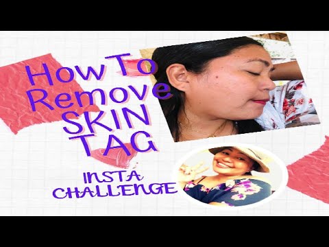 HOW TO REMOVE SKIN TAG I INSTA CHALLENGE ACCEPTED