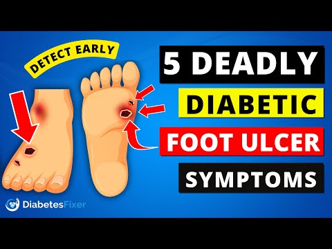 5 DEADLY Diabetic FOOT Ulcer Signs