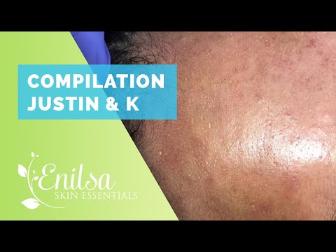 Compilation of “Justin” and “K” Blackheads Extractions