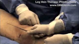 Phlebectomy | Leg Vein Removal | Dr. Mitchel Goldman