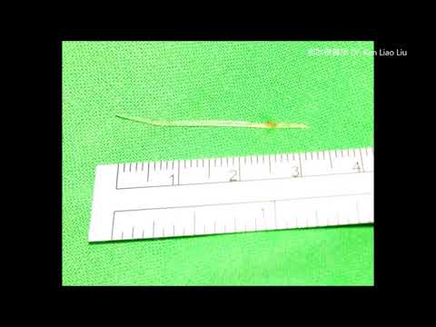 魚刺卡喉嚨：嘗試吞嚥飯糰的危險！3.5 cm  fish bone in deep palatine tonsil