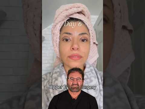 Upper Eyelid Surgery TRANSFORMATION - Surgeon Reacts