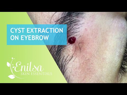 Cyst Extraction on Eyebrow