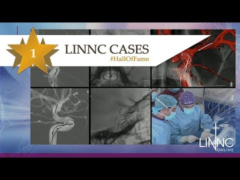 Recorded case of ICA aneurysm treatment