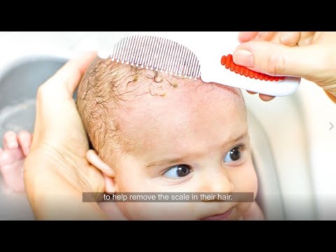 4 cradle cap tips from dermatologists