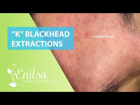 Special "K" Blackhead Extractions 11th Treatment Part 1