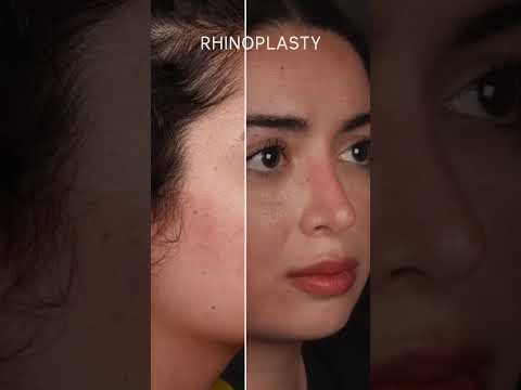 Rhinoplasty Transformation by Assoc. Prof. Dr. Güncel Öztürk | Before & After Results