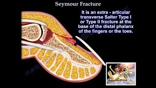 Complex Pediatric Fracture, Seymour Fracture - Everything You Need To Know - Dr. Nabil Ebraheim