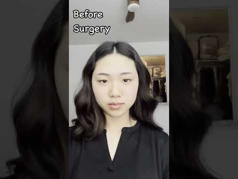 Before and after Facial contouring surgery and rhinoplasty (after one month only!)