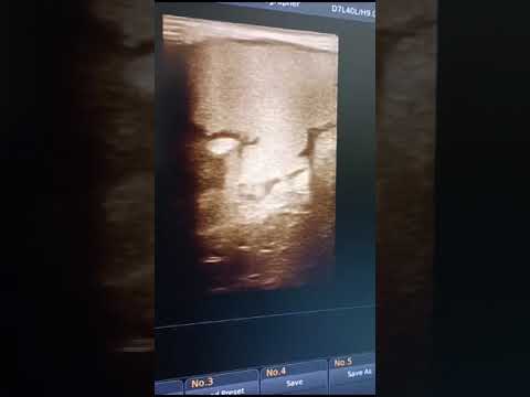 50 year old women side pain  #health #medicalultrasound #ultrasoundtechnologist #ultrasound