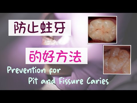 EP 65: 防止蛀牙的好方法 Prevention of pits and fissures caries