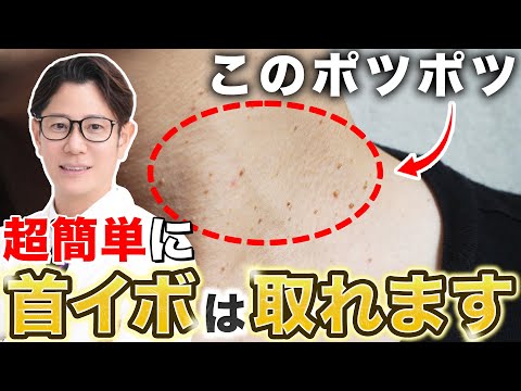 Treatment for a Growth on the Neck: Explained by a Japanese Dermatologist