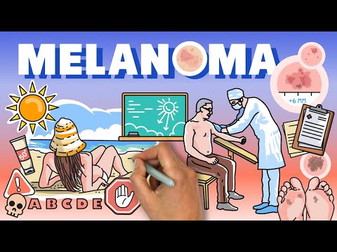 ¿Qué es el melanoma?