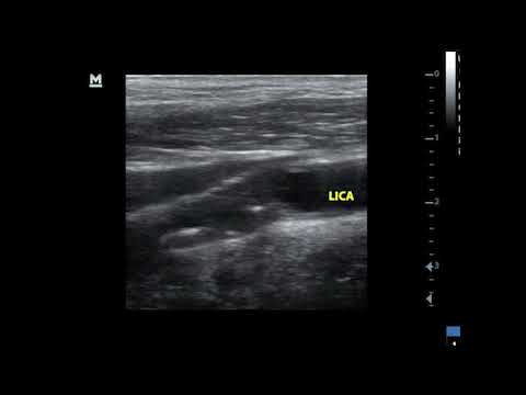 Carotid plaque with ulcer