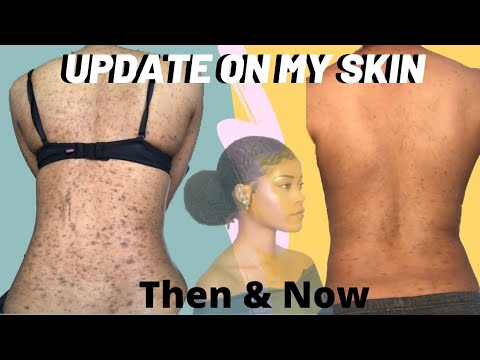 Skin Update | Getting Rid of Dark Spots After Lichen Planus Lichenoid Dermatitis