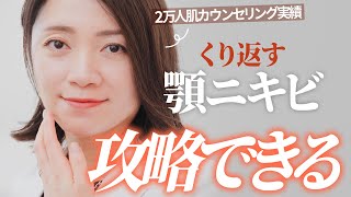 【顎ニキビで悩む人必見】繰り返す顎ニキビの治し方