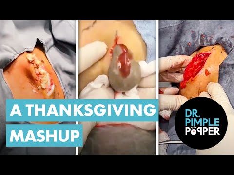 Dr. Pimple Popper's World Famous Thanksgiving Mashup!