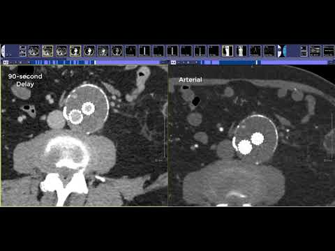 How to read an Endograft CTA