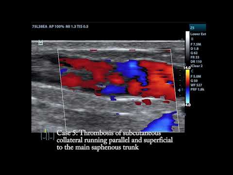 Compilation of various vein thrombosis