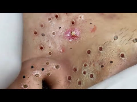 Blackheads New This Week