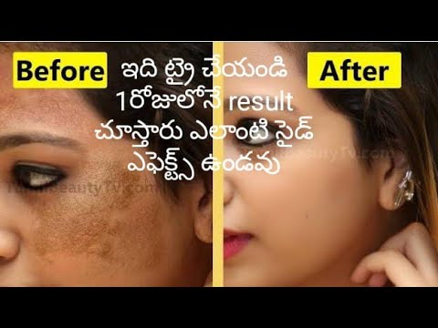 Best home remedy for mangu machalu //How to remove pigmentation, Freckles,Brown spots home remedy...