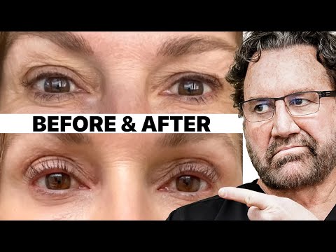 SKIP The Surgery - New Eyelid Lift Treatment | Plastic Surgeon Reacts