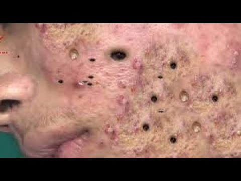 new blackheads this week new