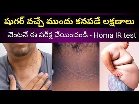 షుగర్ వచ్చే ముందు కనపడే లక్షణాలు - Homa IR Test | Symptoms before heading to Diabetes