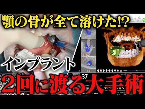 インプラント＆骨再生手術の一部始終を公開