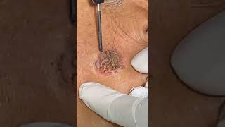 Seborrheic Keratosis at Skinaa clinic #serborrheic_keratosis #skinaaclinic #shorts #createindia