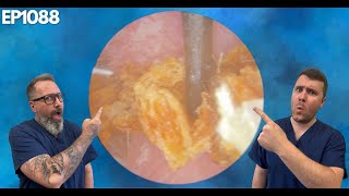 Removing Dry Ear Wax and Finding Severe Eardrum Retraction - EP1088