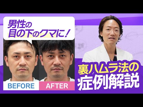 【男性のクマは女性とは違う!?】男性の裏ハムラ法の症例解説