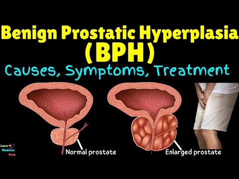 Benign Prostatic Hyperplasia (BPH) | Enlarged Prostate | BPE – Causes, Symptoms, Treatment